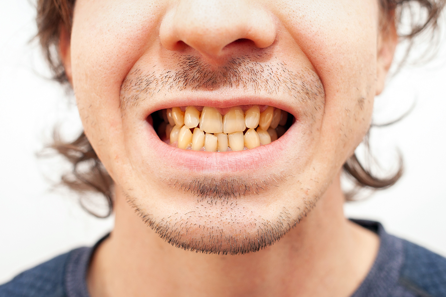 Yellowish teeth stained by long-term tobacco consumption