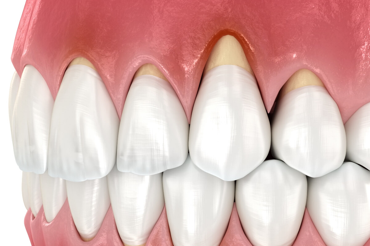 Gum recession: the gums pull back and expose the root of the tooth, frequent in smokers