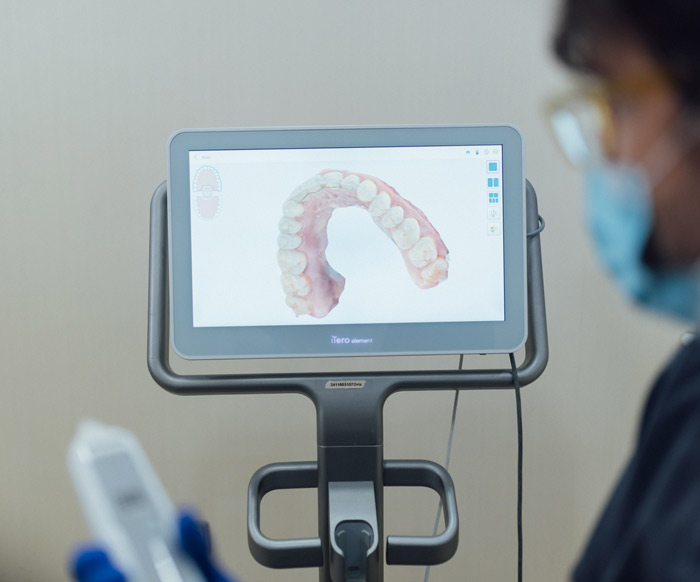 Escàner intraoral iTero